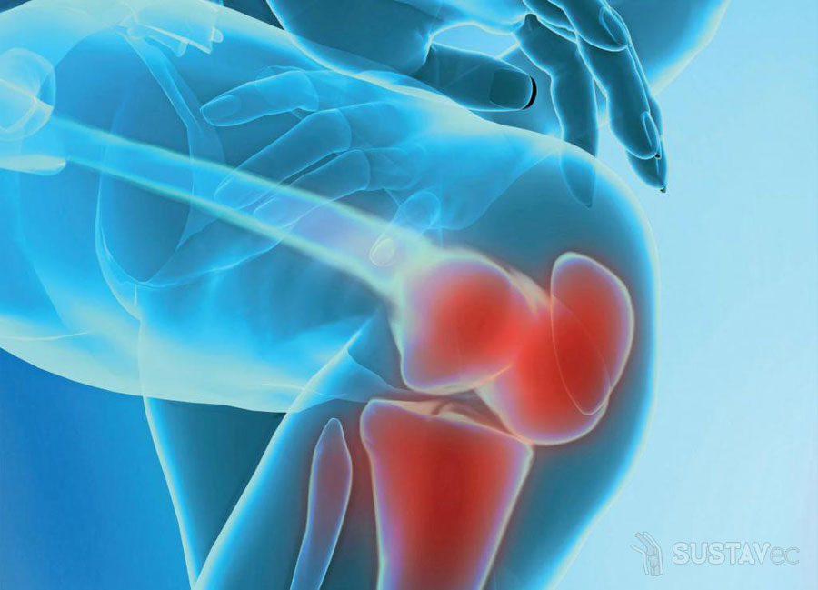 Ревматоидный артрит коленного сустава: симптомы и лечение 17-4