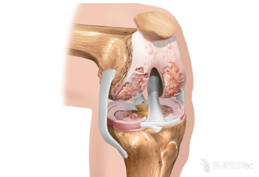 Симптомы и лечение воспаления коленного сустава: топ 6 методик 24-2