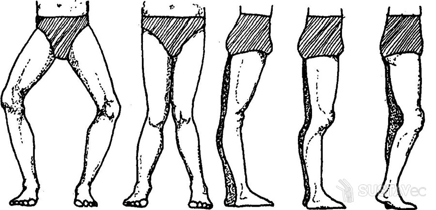 Вальгусная деформация коленных суставов: 4 методики лечения 27-3