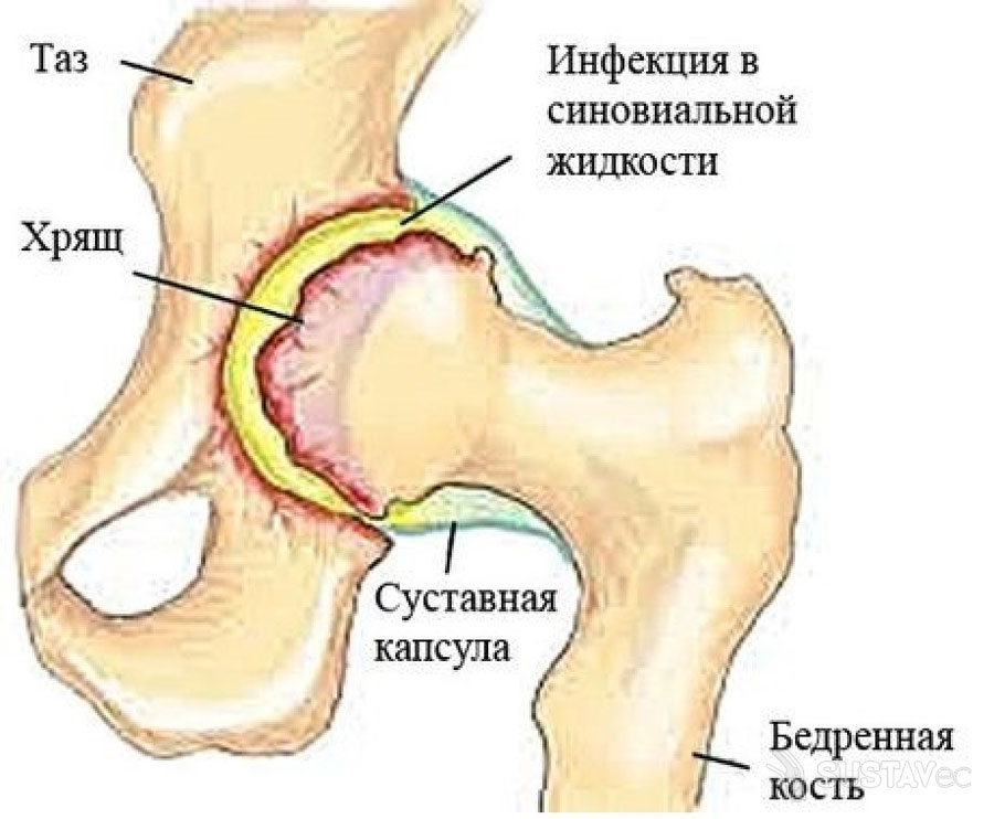 Медицинская желчь при артрозе коленного сустава: методики лечения 35-2