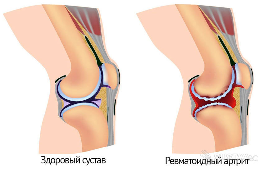 Симптомы и лечение остеоартрита коленного сустава 37-2