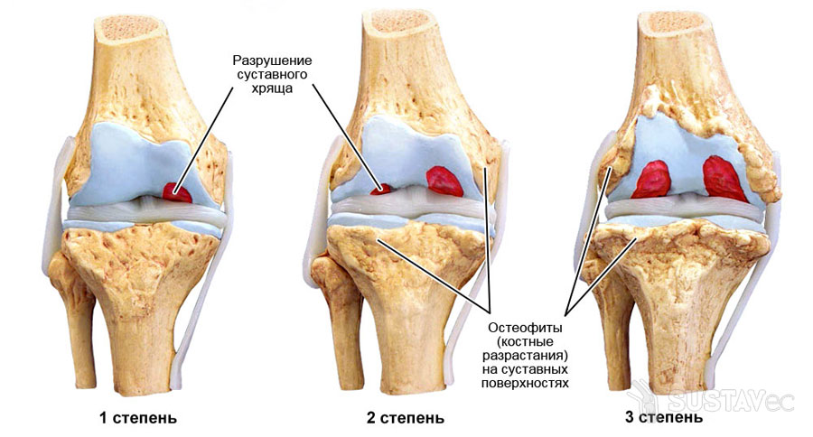 Лечение остеоартроза коленного сустава 1 степени и правильная профилактика 38-2