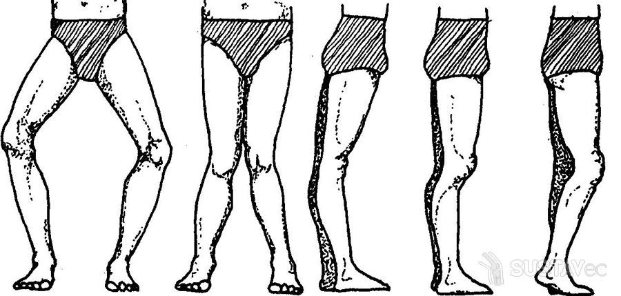 Варусная деформация коленных суставов: причины и лечение 58-2