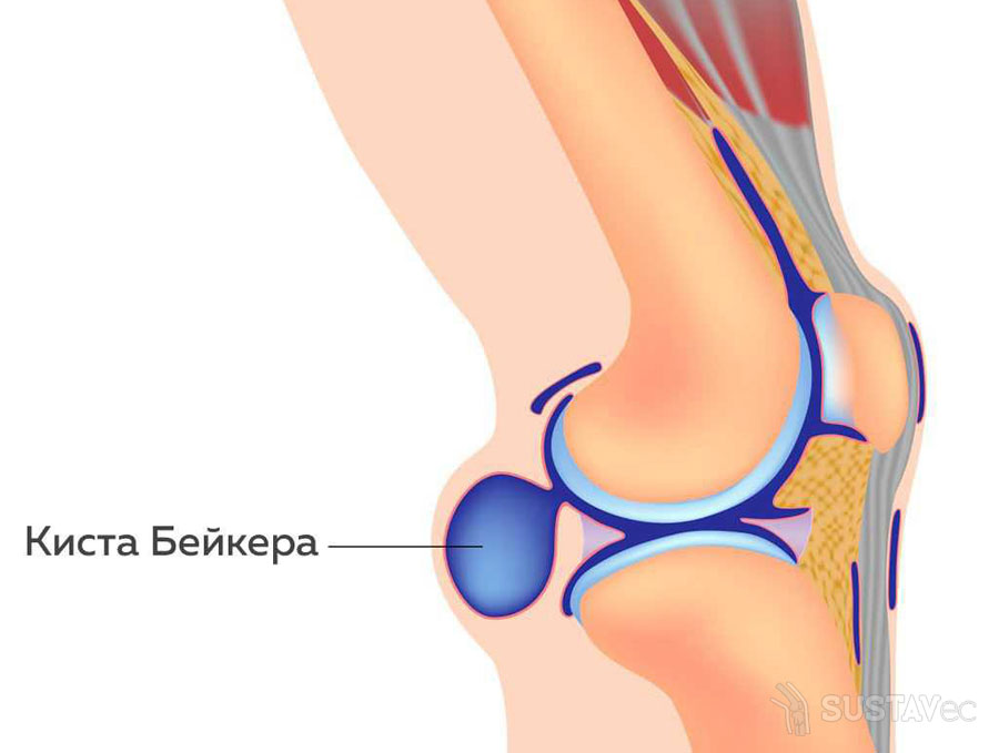 Лечение кисты Бехтерева в коленном суставе: 2 лучших методики 60-2