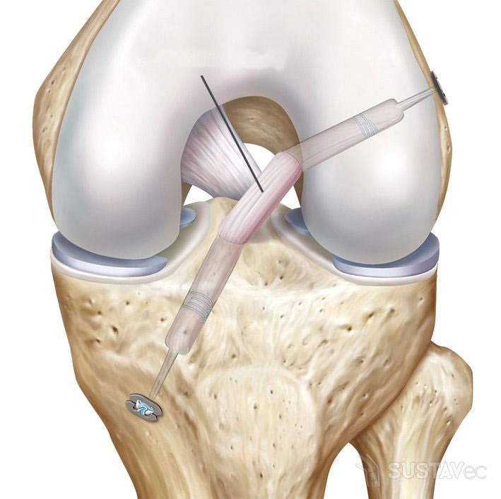 Разрыв передней крестообразной связки коленного сустава: можно ли обойтись без операции? 62-2
