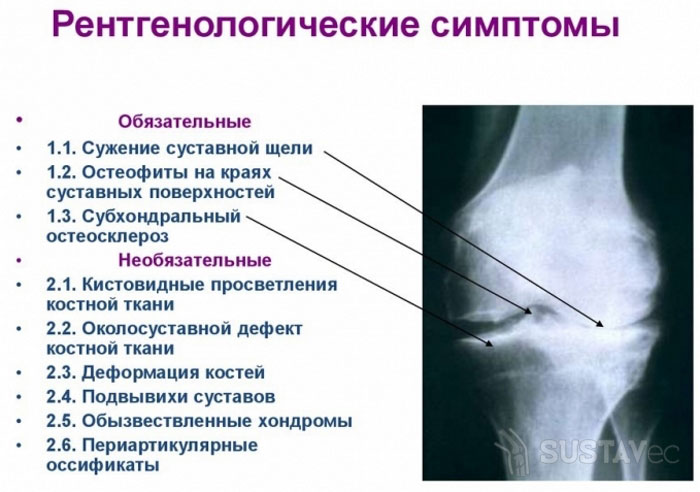 Субхондральный склероз тазобедренного сустава 9-2