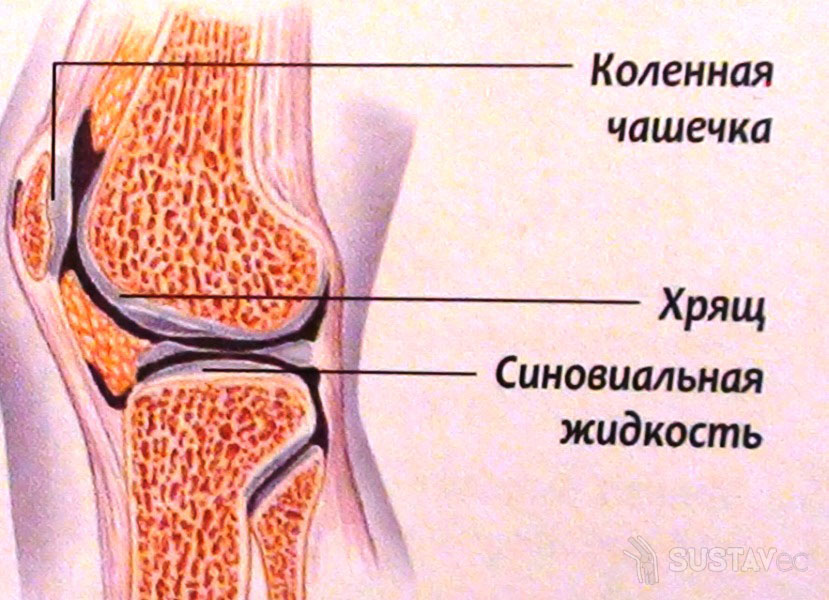 Лечение синовиальной жидкости в коленном суставе 1-7