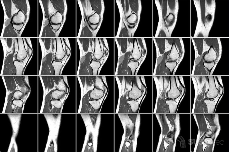 Что показывает МРТ коленного сустава: отличия от УЗИ 14-2