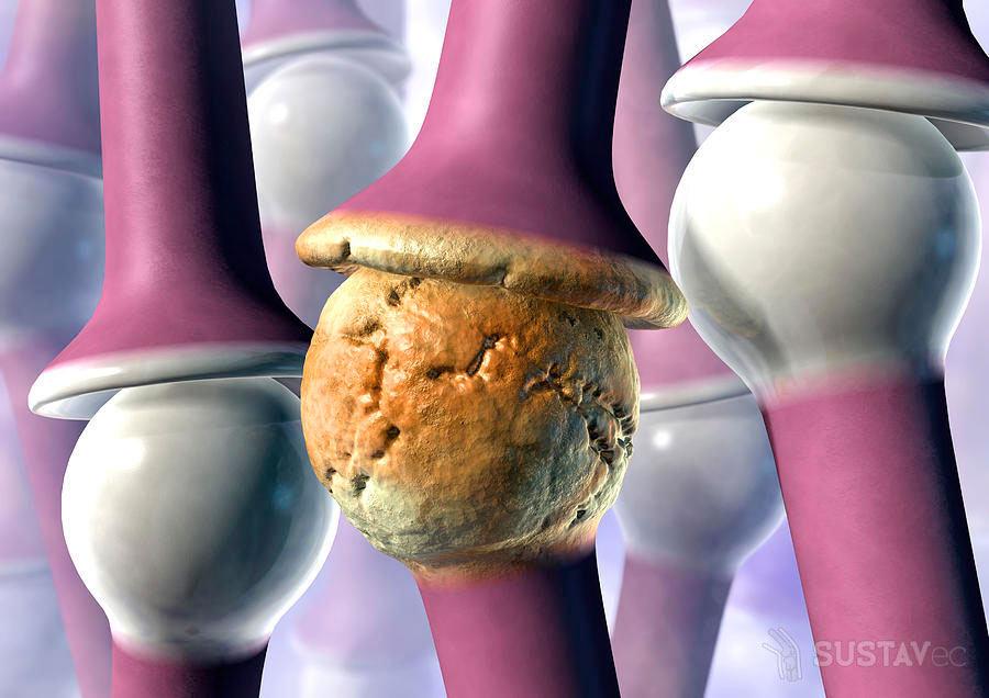Ревматоидный артрит коленного сустава: симптомы и лечение 17-5