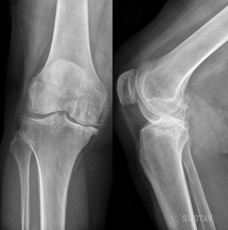Остеопороз коленного сустава: симптомы и лечение 9-3
