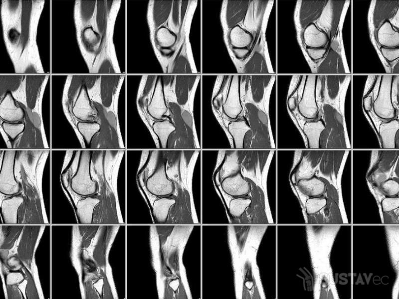 Остеопороз коленного сустава: симптомы и лечение 9-4