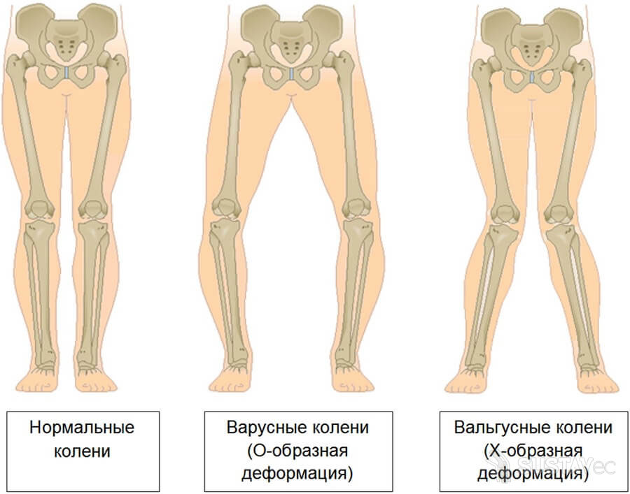 Вальгусная деформация коленных суставов: 4 методики лечения 27-2