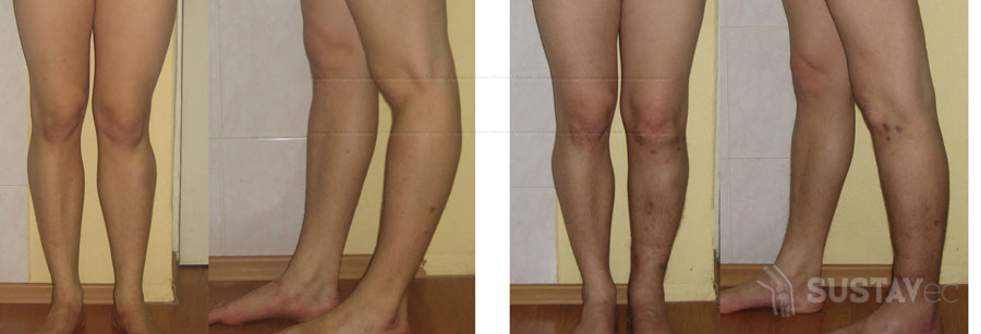 Вальгусная деформация коленных суставов: 4 методики лечения 27-4