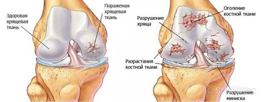 Лечение деформирующего остеоартроза коленного сустава 2 степени: симптомы и стадии 36-2