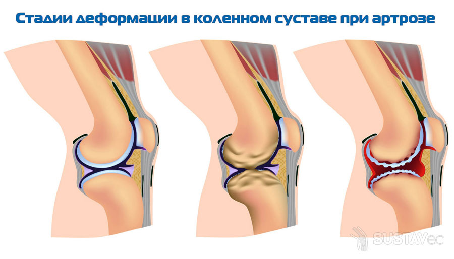 Лечение деформирующего остеоартроза коленного сустава 2 степени: симптомы и стадии 36-3