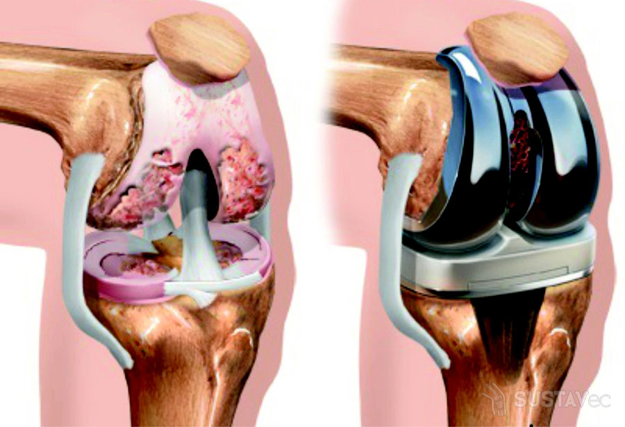 Как лечить гонартроз коленного сустава 2 степени: 6 методик 44-2
