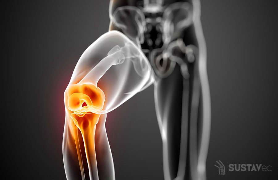 Признаки гонартроза коленного сустава: не пропусти первые симптомы 45-2