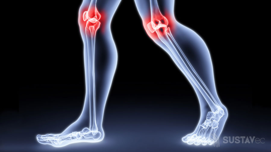 Лечение артрита и артроза коленного сустава: 7 лучших способов 47-3