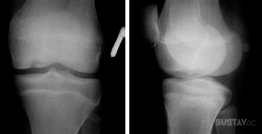 Болезнь Кенига коленного сустава: причины и лечение 50-2