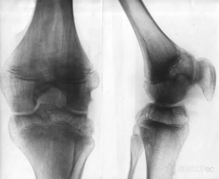 Хондроматоз коленного сустава: лечение и своевременная диагностика 55-2