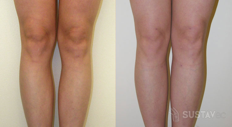 Варусная деформация коленных суставов: причины и лечение 58-3
