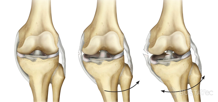 Изображение - Частичный разрыв передней крестообразной связки коленного сустава 64-2