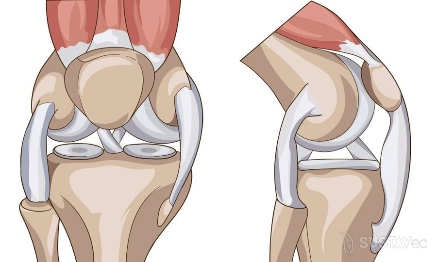 Лечение после травмы мениска коленного сустава: методики и упражнения 71-2