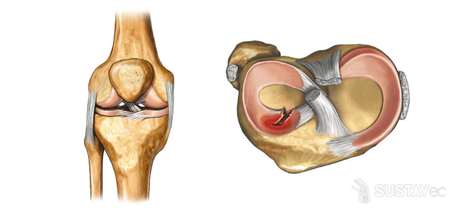 Лечение после травмы мениска коленного сустава: методики и упражнения 71-4