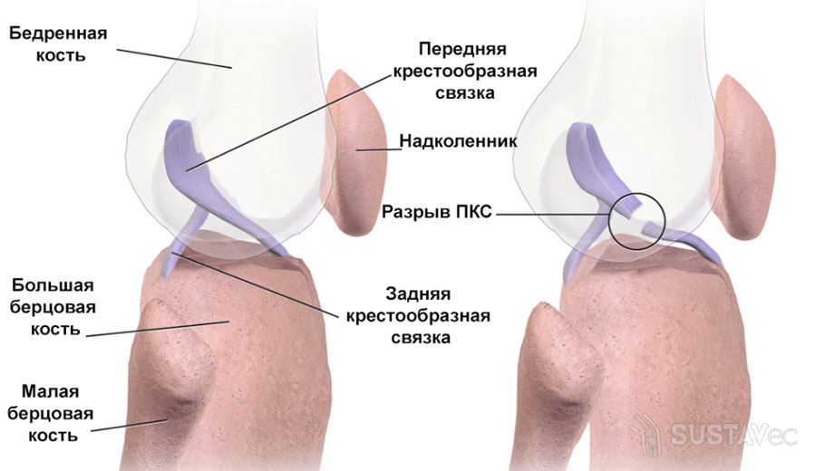 Симптомы и лечение повреждения связок коленного сустава 78-4
