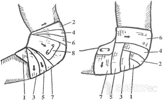 Техника наложения черепашьей повязки на локтевой сустав 1-3
