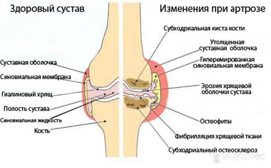 Симптомы и лечение артрита локтевого сустава 16-1