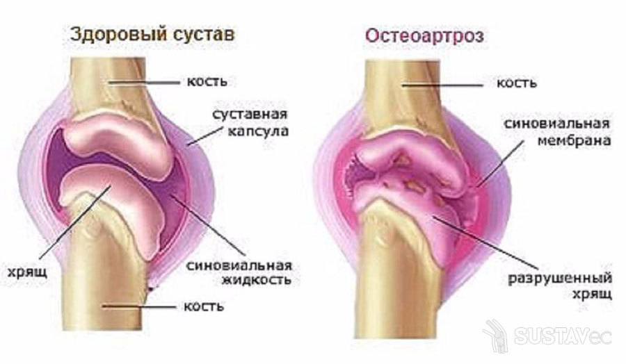 Остеоартроз локтевого сустава и его степени 33-3