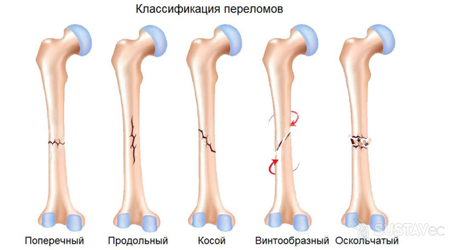 Переломы венечного отростка локтевой кости 40-1