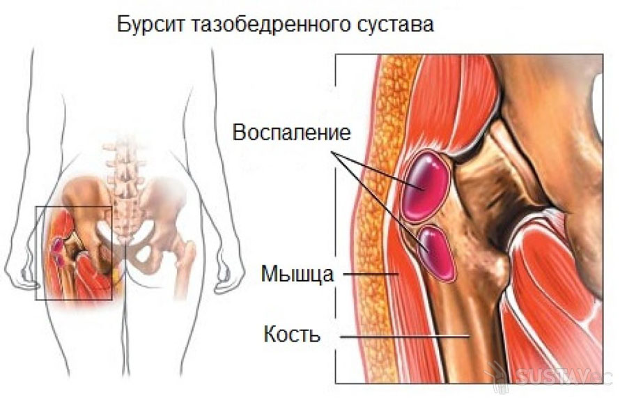 Изображение - Боли левом тазобедренном суставе лечение 7-2