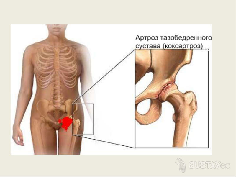Изображение - Боли левом тазобедренном суставе лечение 7-3